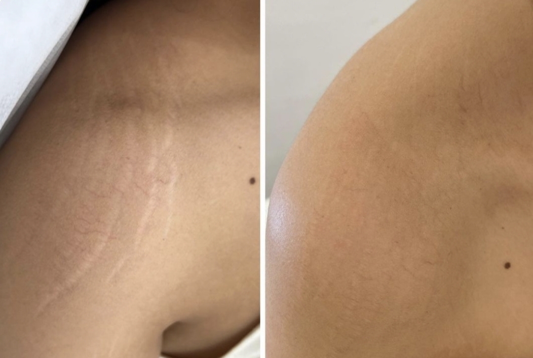 Nue Conceal shoulder stretch mark repair before and after stretch mark remedy